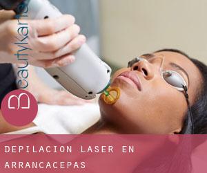 Depilación laser en Arrancacepas
