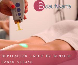 Depilación laser en Benalup-Casas Viejas