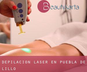 Depilación laser en Puebla de Lillo